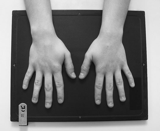 Radiografie postero-anterioară (PA) normală, ambele mâini