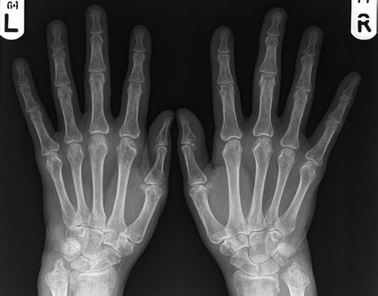 Radiografie postero-anterioară (PA) a ambelor mâini, evidențiind boală erozivă severă