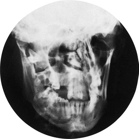 Figura 2: Aspect radiografic / Poziționare (Clark Ed. 12)