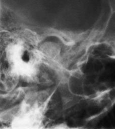 Figura 5: Aspect radiografic / Poziționare (Clark Ed. 12)