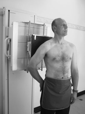 Poate exista și o suspiciune subiacentă de fractură costală.