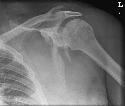 Radiografie anteroposterioară (AP) a omoplatului (scapulei), evidențiind o suspiciune de fractură prin