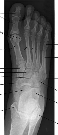 Radiografie dorso-plantară normală a piciorului