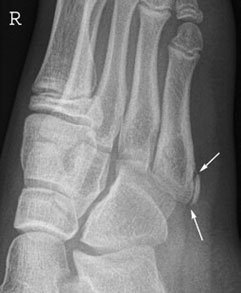 Dorso-plantară normală