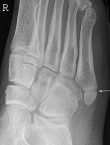 Radiografie oblică a piciorului
