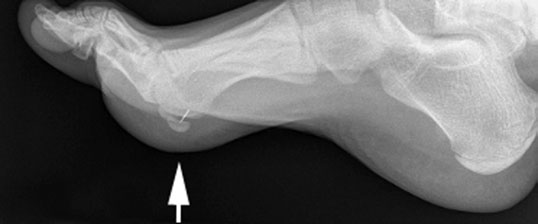 Radiografie normală de profil a piciorului