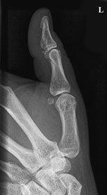 Radiografie normală anteroposterioară (AP) a policelui