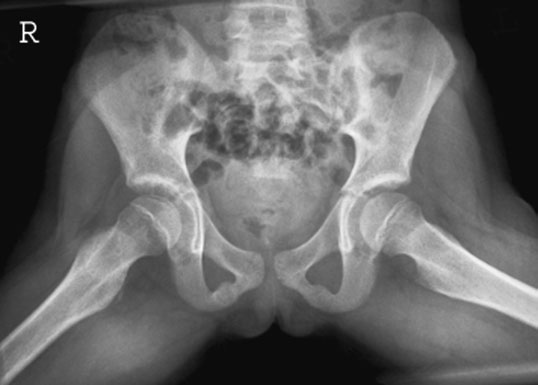 Radiografie normală care evidențiază ambele șolduri în incidență de profil (membre inferioare în poziție de broască)