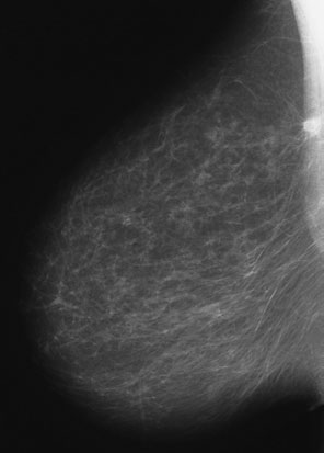 • Dacă nu este vizualizat întregul țesut mamar, atunci mâna radiografului