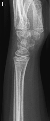 Radiografie normală de profil (laterală)