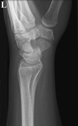 Radiografie postero-anterioară (PA) a