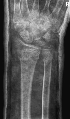 Radiografie postero-anterioară (PA) a pumnului (articulației radiocarpiene)