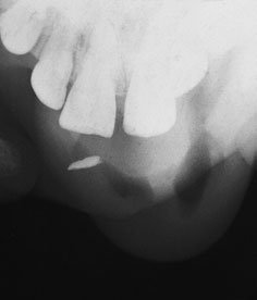 Radiografie ocluzală oblică standard