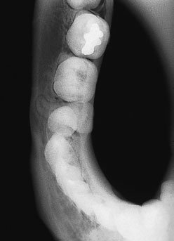 Radiografie dentară ocluzală