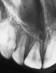 Radiografie Dentară Retroalveolară (Periapicală)