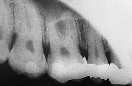 regiunea radiografiei retroalveolare a fost