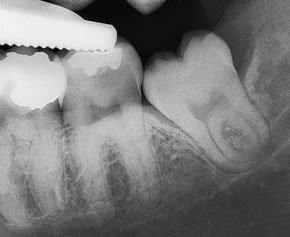 Radiografia retroalveolară a molarului de minte inferior stâng evidențiind rădăcina complexă