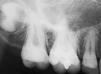 Radiografie Dentară Retroalveolară (Periapicală)
