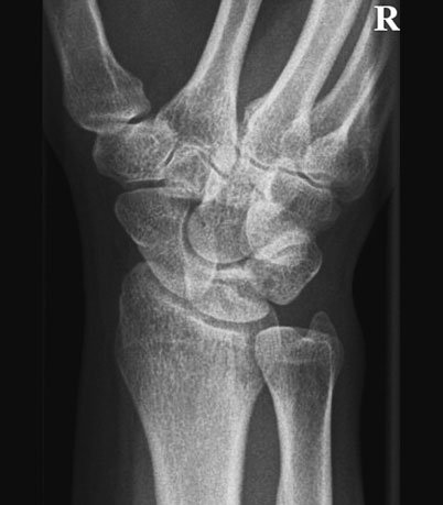 Radiografie oblică anterioară normală a scafoidului carpian