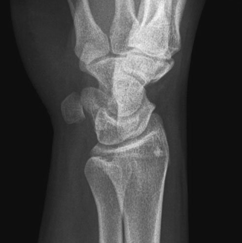 Radiografie oblică posterioară normală a pumnului (articulației radiocarpiene)