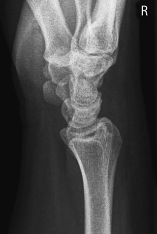Radiografie de profil (laterală) a pumnului (articulației radiocarpiene)