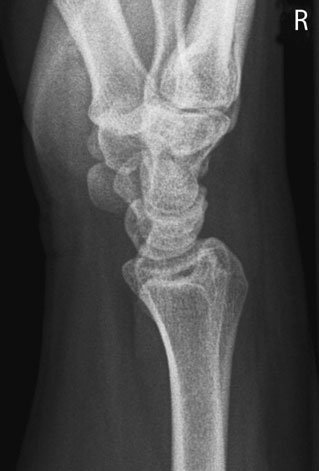 Radiografie normală de profil (laterală) a pumnului (articulației radiocarpiene)