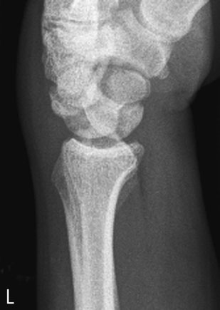 Radiografie de profil (laterală) a pumnului (articulației radiocarpiene), evidențiind luxația articulară a semilunarului. semilunarul