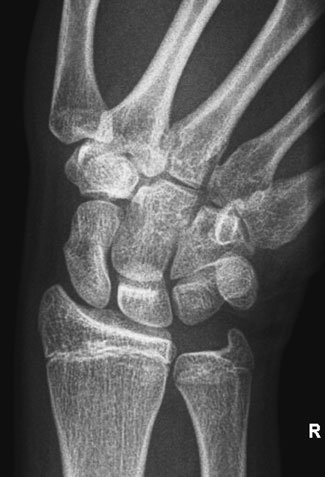 Radiografie anteroposterioară (AP) a pumnului (articulației radiocarpiene)