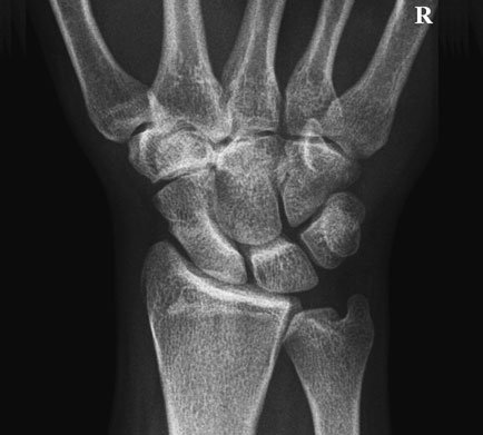 Radiografie postero-anterioară (PA) normală a scafoidului carpian în deviație ulnară