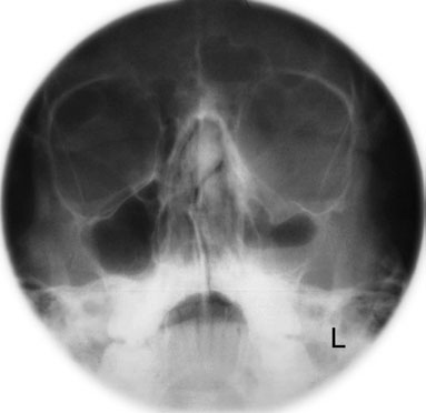 Radiografia PNS se efectuează de obicei la copii cu vârsta între patru