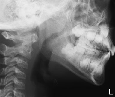 evidențiind suspiciunea de fractură blowout a marginii orbitare inferioare stângi, cu lichid