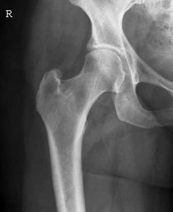 Radiografie Antero-posterioară (AP) a șoldului unilateral, evidențiind pinul și placa in situ