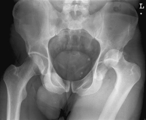 Bazin anteroposterior (AP) evidențiind o suspiciune de fractură a ischionului și pubisului, cu întreruperea