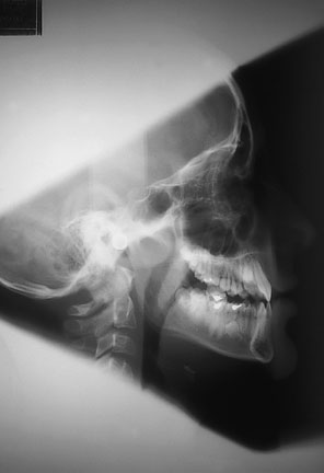 înainte de efectuarea radiografiei.