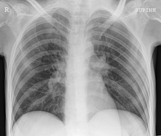 • Biomecanica normală a fluxului sanguin este diferită față de [fragment incomplet în sursă].