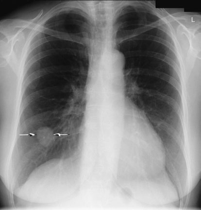 Radiografii postero-anterioară (PA) și de profil ale aceluiași pacient, evidențiind un proces proliferativ tumoral în [fragment incomplet în sursă].