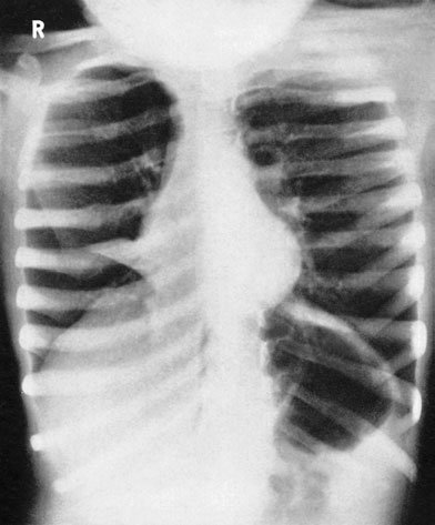 Radiografie lordotică postero-anterioară (PA) evidențiind colapsul lobului mijlociu