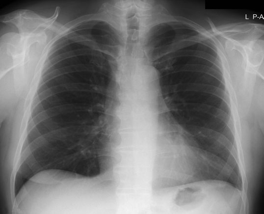Radiografia toracică postero-anterioară (PA) ideală trebuie să evidențieze [fragment incomplet în sursă].