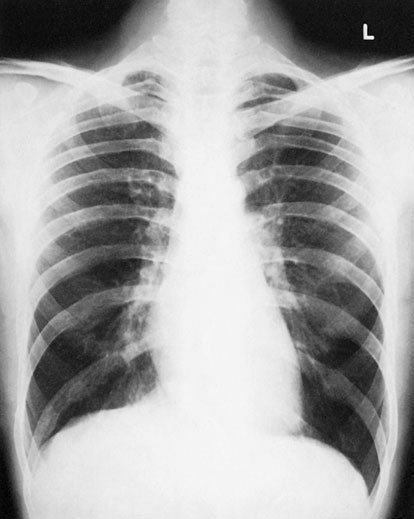 [Fragment incomplet în sursă] ar putea imita prezența lichidului pleural sau chiar un pneumotorax. Formarea cutelor [fragment incomplet în sursă].