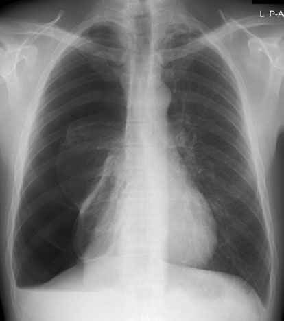 • Markerul postero-anterior (PA) de tip clips este utilizat în mod normal, iar [fragment incomplet în sursă].