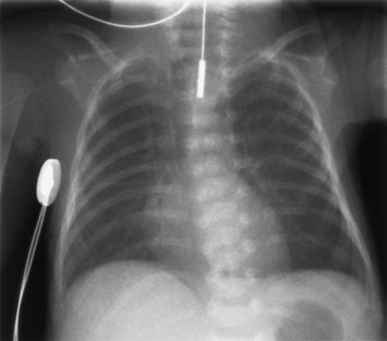 • Supraexpunerea radiografiilor toracice neonatale duce la pierderea