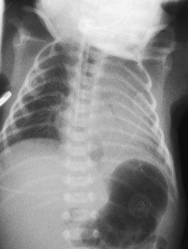 imaginii unei radiografii toracice neonatale normale poziționate corect