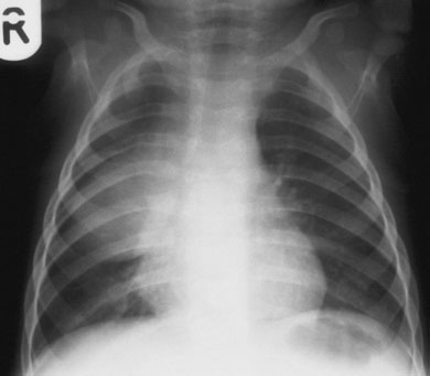 radiografie cu lordoză toracică excesivă, extremitățile coastelor apar la