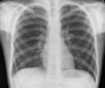 • Interpretarea corectă a radiografiilor toracice pediatrice necesită