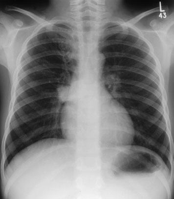 Înclinare. Radiograful trebuie să urmărească toracele copilului/