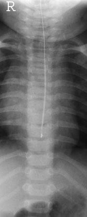 • Densitate optică incorectă – este necesară experiența radiografului în evaluarea