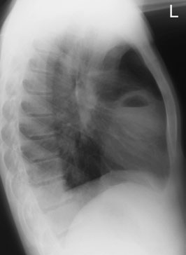 Radiografie toracică de profil (lateral) evidențiind abces pulmonar și niveluri hidroaerice
