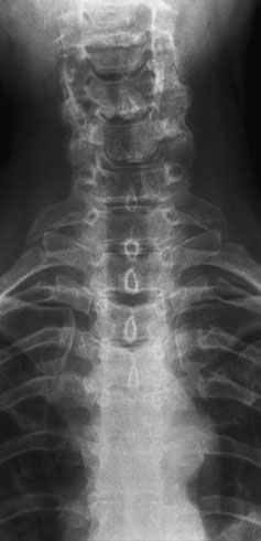 și pentru a aduce linia de bază radiografică la un unghi de 20 grade