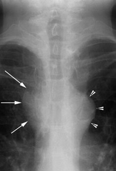Radiografie antero-posterioară (AP) evidențiind trahee normală