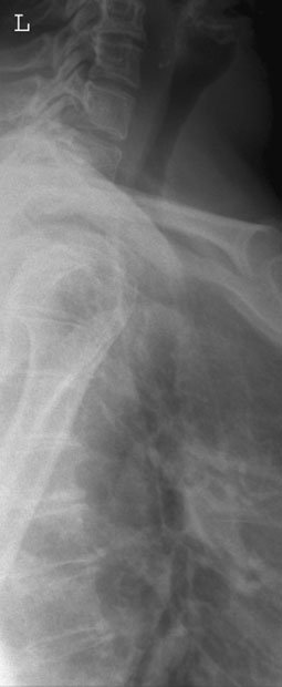 Radiografie de profil (lateral) evidențiind
